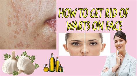 How To Get Rid Of Flat Warts Top 10 Home Remedies