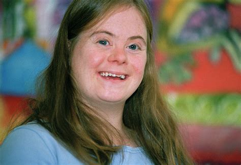 Down S Syndrome Woman Photograph By Joti Science Photo Library