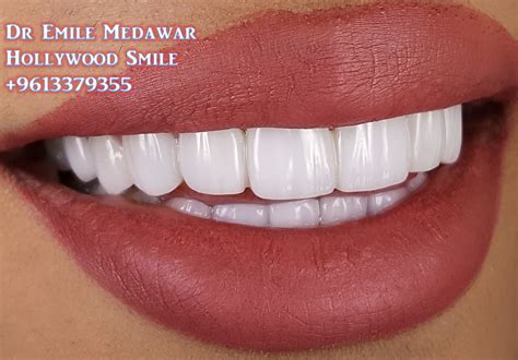 · dental bonding · veneers · crowns · enamel shaping · orthodontics (braces) · types . Cosmetic Dentistry, Beautiful Hollywood Smile, Ultra-Thin ...