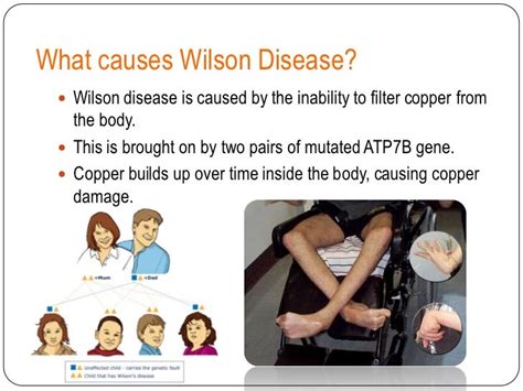 Symptoms Of Wilsons Disease Wilsons Healthresource4u Diseases