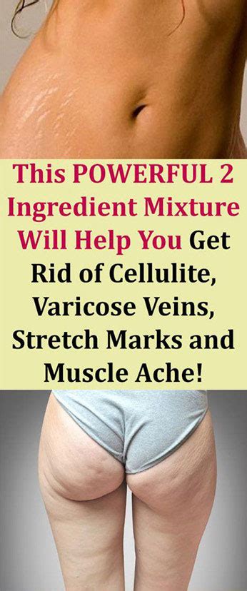 This Powerful 2 Ingredient Mixture Will Help You Get Rid Of Cellulite Varicose Veins Stretch