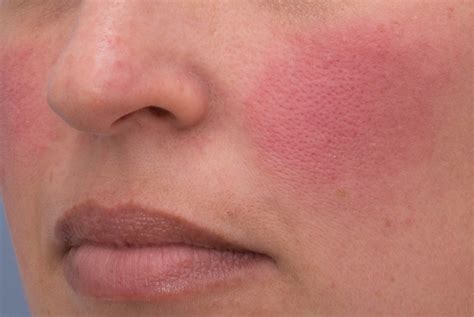 Treating Rosacea In Summer — Skin Depth Dermatology