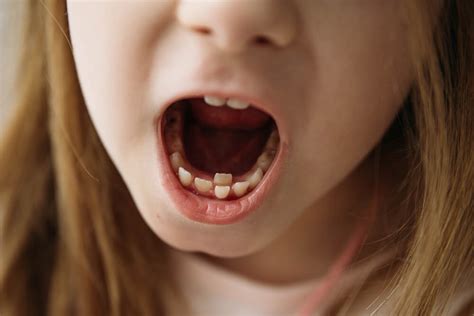 Two Rows Of Teeth In Adults