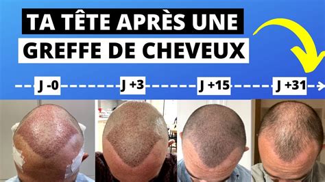 Quelle Tête on a après une Greffe de Cheveux le 1er mois ? Jour par