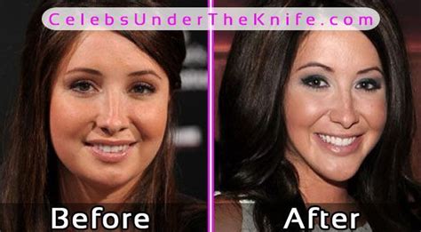 The procedure is generally performed by an oral surgeon to correct a variety of skeletal irregularities. Bristol Palin Photos Before After Plastic Surgery ...