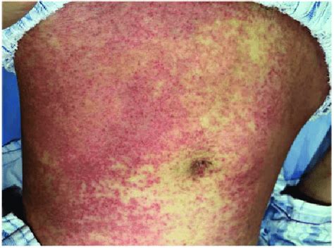 Representative Image Showing Diffuse Red Subcutaneous Nodules On The