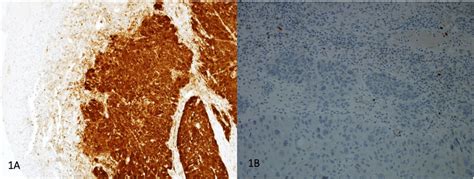 Examples Of Ihc Staining Of A P16 Positive Patient 1a And Of A P16