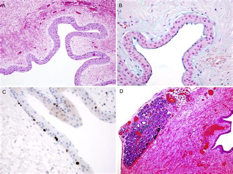 Developmental Conjunctival Cyst Of The Eyelid In A Child Journal Of