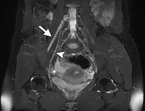 High Resolution 3 T Mr Neurography Of The Lumbosacral Plexus