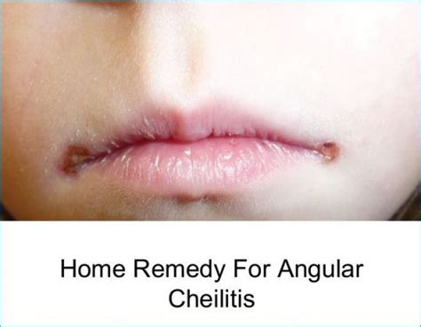 Best Natural Home Remedies For Angular Cheilitis Yabibo