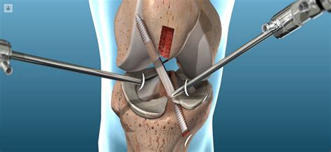 reconstrucción del ligamento cruzado anterior qué es síntomas y tratamiento top doctors