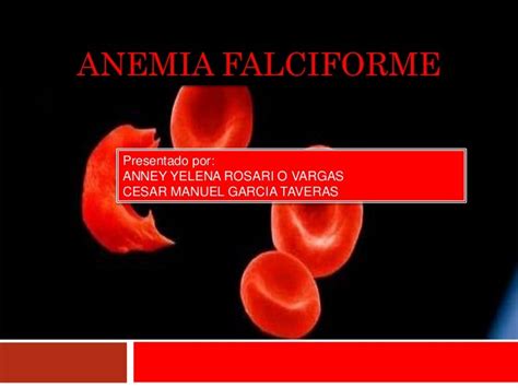 Anemia Falciforme