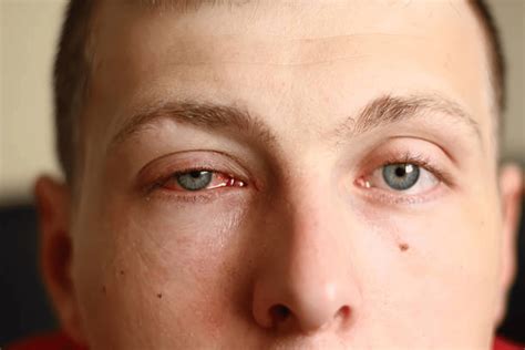 Itchy Eyes Allergy Symptoms Without