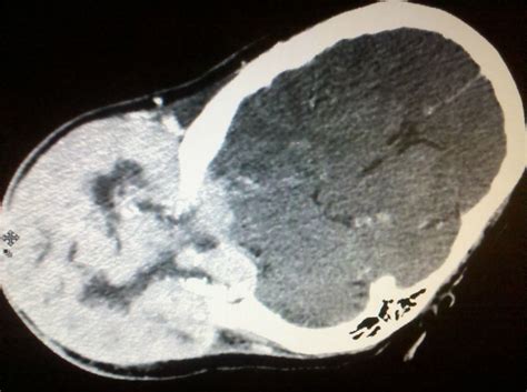 Tumor X Ray Picture Of Brain Tumor