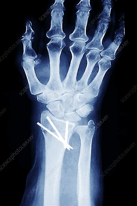 Pinned Wrist Fracture X Ray Stock Image M3301359 Science Photo