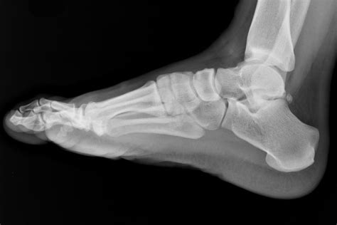 Poor physical condition.poor strength or flexibility in the ankles may increase the risk of a sprain when participating in sports. When do you need an x-ray after twisting your ankle? - The ...