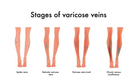 Chronic Venous Insufficiency El Paso Tx Imaging Interventional Specialists