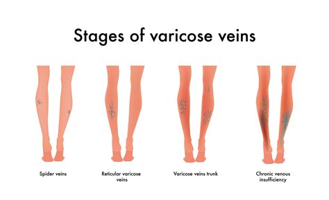 Chronic Venous Insufficiency El Paso Tx Imaging And Interventional