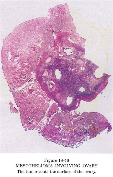 Understanding mesothelioma pathology, how the disease develops and spreads, is essential for making a proper diagnosis and developing the best treatment plan. Pathology Outlines - Mesothelioma