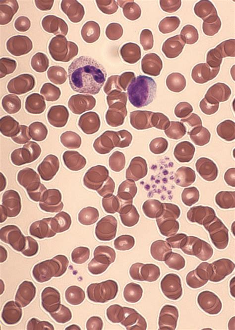 Thrombocytopenia — Symptoms And Treatment Online Medical Library