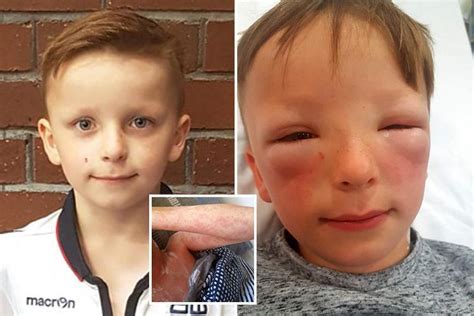 Shocking Photos Reveal How Serious Hay Fever Gets As Boys Face