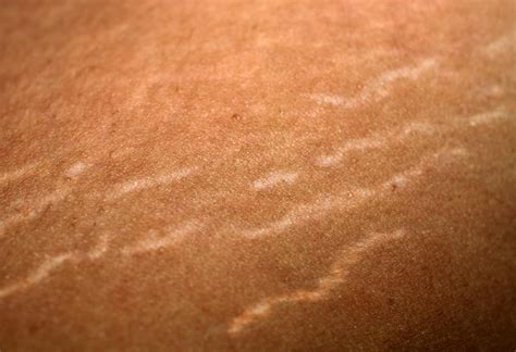 Stretch Mark Removal Treatments And Home Remedies