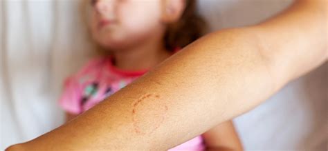 Ouch Understanding Why Children Bite And How To Best Respond