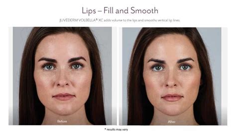 Lip Fillers With Juvéderm