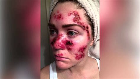 Mom Shares Skin Cancer Selfie To Show The Dangers Of Tanning Youtube