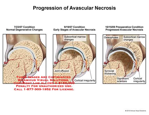 Progression Of Avascular Necrosis