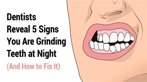 Dentists Reveal 5 Signs You Are Grinding Teeth At Night And How To Fix It