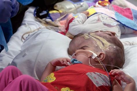 Rare Craniopagus Twins Successfully Separated After 50 Hour Surgery