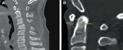Posterior C1 Stabilization Using Superior Lateral Mass As An