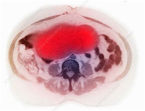 Ovarian Cancer On Ct Scan Stock Image F0189117 Science Photo Library