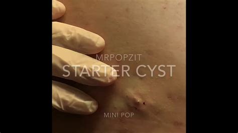 Juicy Cyst Pop On Back Must See Youtube