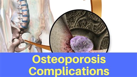 Osteoporosis Complications YouTube