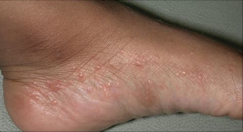 What Is Dyshidrotic Eczema Blisters On Fingers Hands