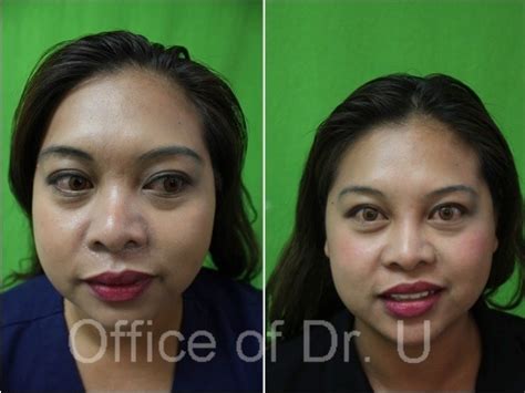 Incredible Non Surgical Nose Job Before And After Asian 2022 My Reff