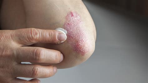 How the skin disease psoriasis costs us billions | MPR News