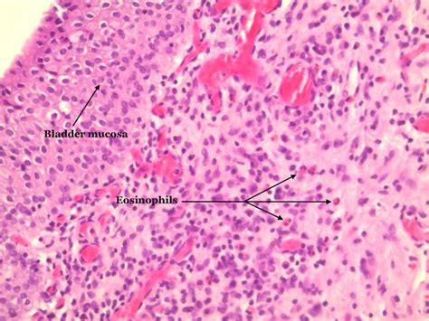 Eosinophilic Cystitis Three Cases And A Review Over 10 Years Bmj