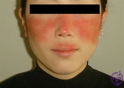 Skin Systemic Lupus Erythematosus SLE Pathology Core Pictures