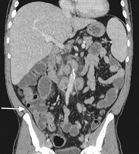 Black Spots On Ct Scan Of Abdomen Splashstory