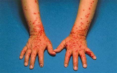Diagnosing Blistering Skin Conditions Gponline