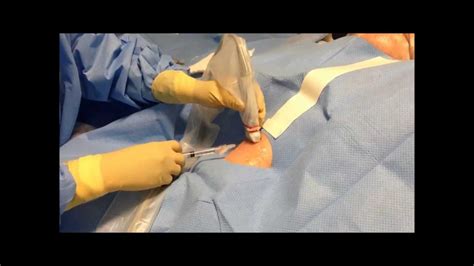 Midline Insertion Confirming Tip Location Using Ultrasound Youtube