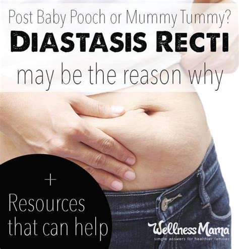 How To Know If You Have Diastasis Recti And What To D