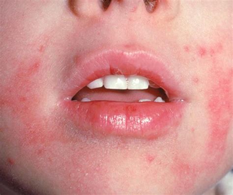 Dermatita Atopica Eczema Atopica