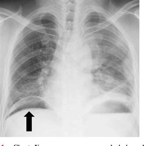 Figure 1 From Malignant Pleural Mesothelioma Presenting As An Acute
