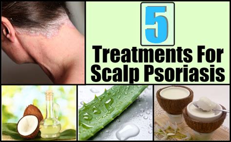 5 Best And Effective Ways For Scalp Psoriasis Treatments Natural Home