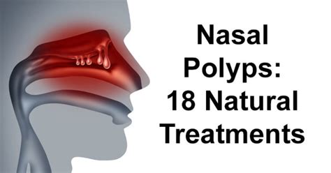 Nasal Polyps Natural Treatments David Avocado Wolfe