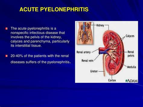 PPT ACUTE PYELONEPHRITIS PowerPoint Presentation ID